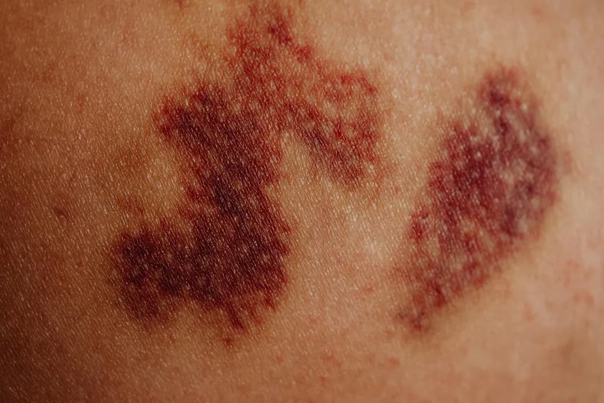 Discoloration — health symptom