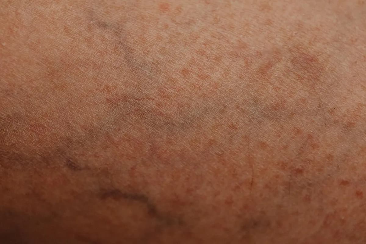 Visible Veins — health symptom