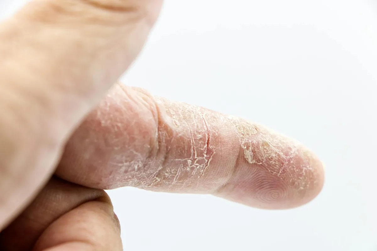 Atopic dermatitis — health condition