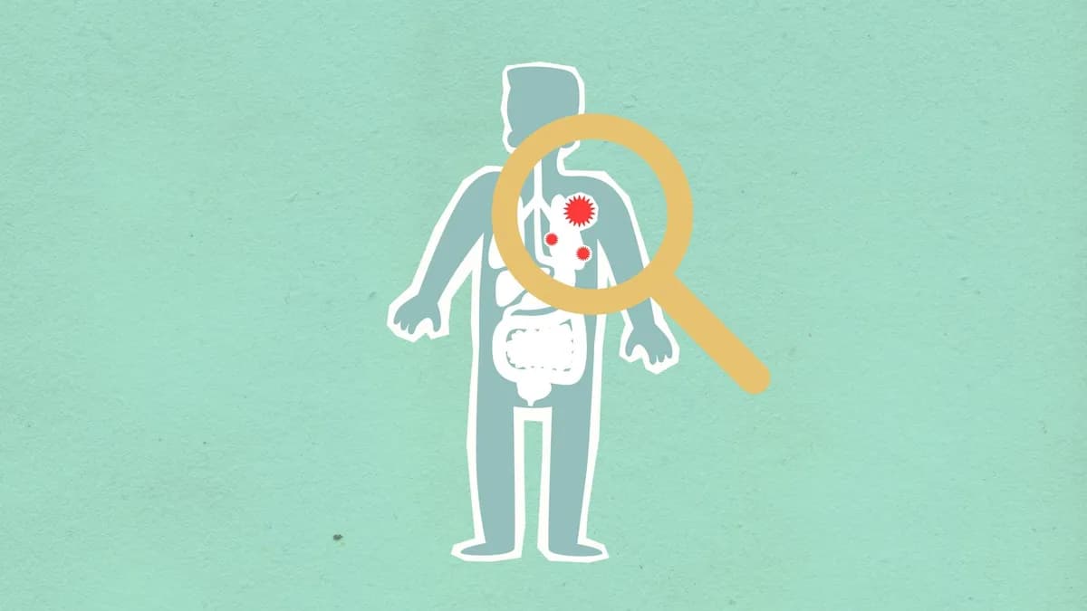 Crohn disease — health condition