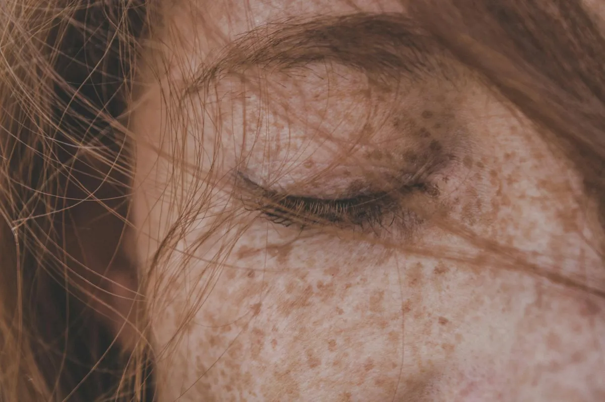 Hyperpigmentation — health condition