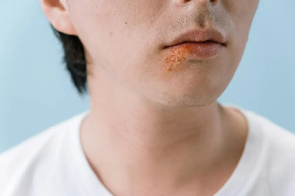 Perioral dermatitis — health condition