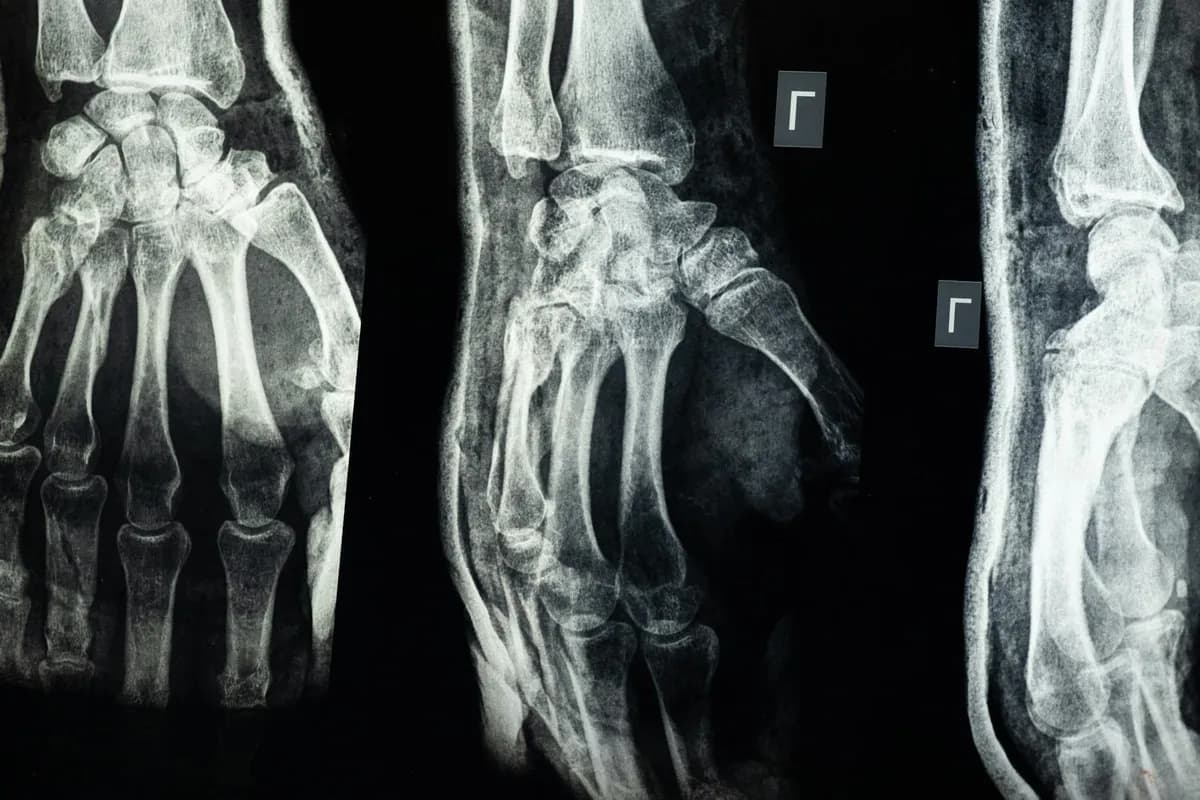 Weak Bones — health symptom